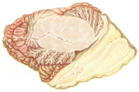 медуллобластома мозжечка